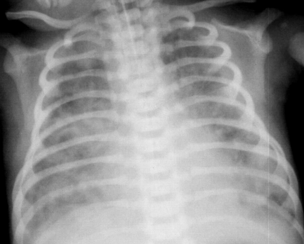 Meconium aspiratiós szindróma Érett vagy túlhordott t csecsemık Intrauterin hypoxia Körülírt rt foltos