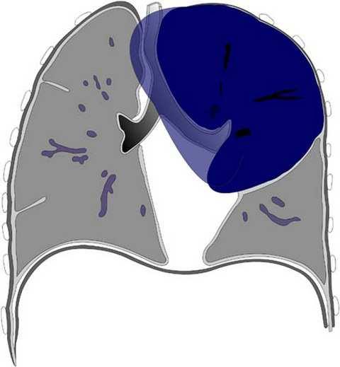 Congenitális lobaris emphysema 1 lebenyt érint 50 %-ban% a bal felsı