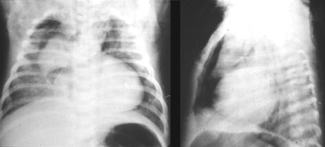 Levegısz szökés PTX Pneumomediastinum Pneumopericardium
