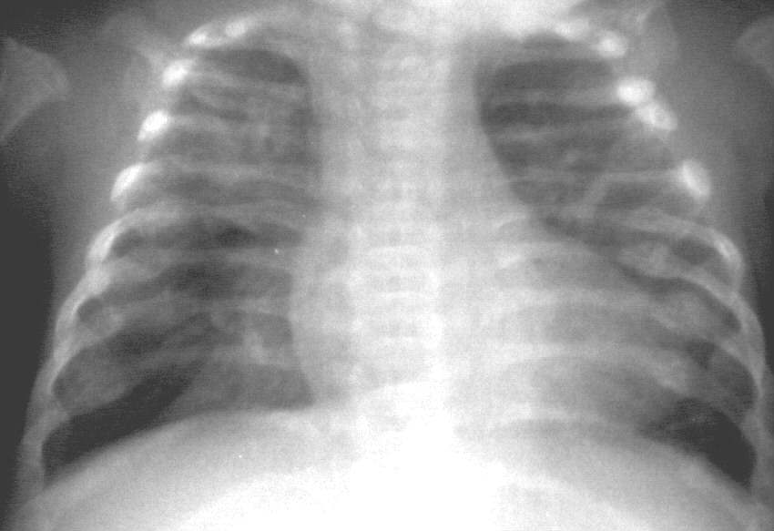 Mellkasi traumák Fractura (borda, csigolya, sternum) Subcutan emphysema PTX