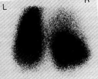 Egyéb b vizsgáló módszerek Izotóp p vizsgálat: aspecifikus Angiographia: : CT
