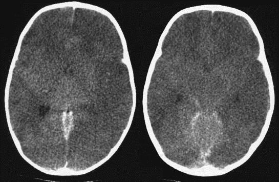 Diffúz agyoedema Enyhétől