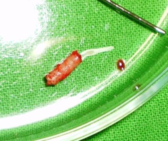 Módszerek, Sebészi beavatkozások II. 6 hónapos gyógyulási időt követően a újra feltártuk a gyógyuló alveolusokat.