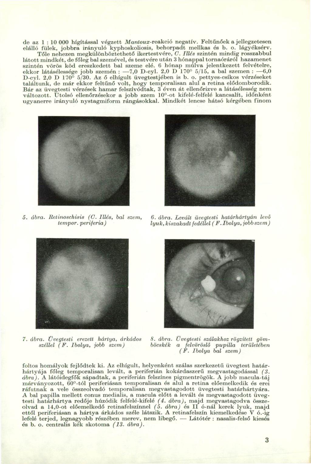 de az 1 : 10 000 hígítással végzett Mantoux-reakció negatív. Feltűnőek a jellegzetesen elálló fülek, jobbra irányuló kyphoskoliosis, behorpadt mellkas és b. o. lágyéksérv.