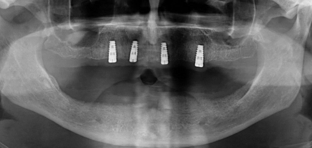 RTG Status implantációs műtétek után A behelyezett