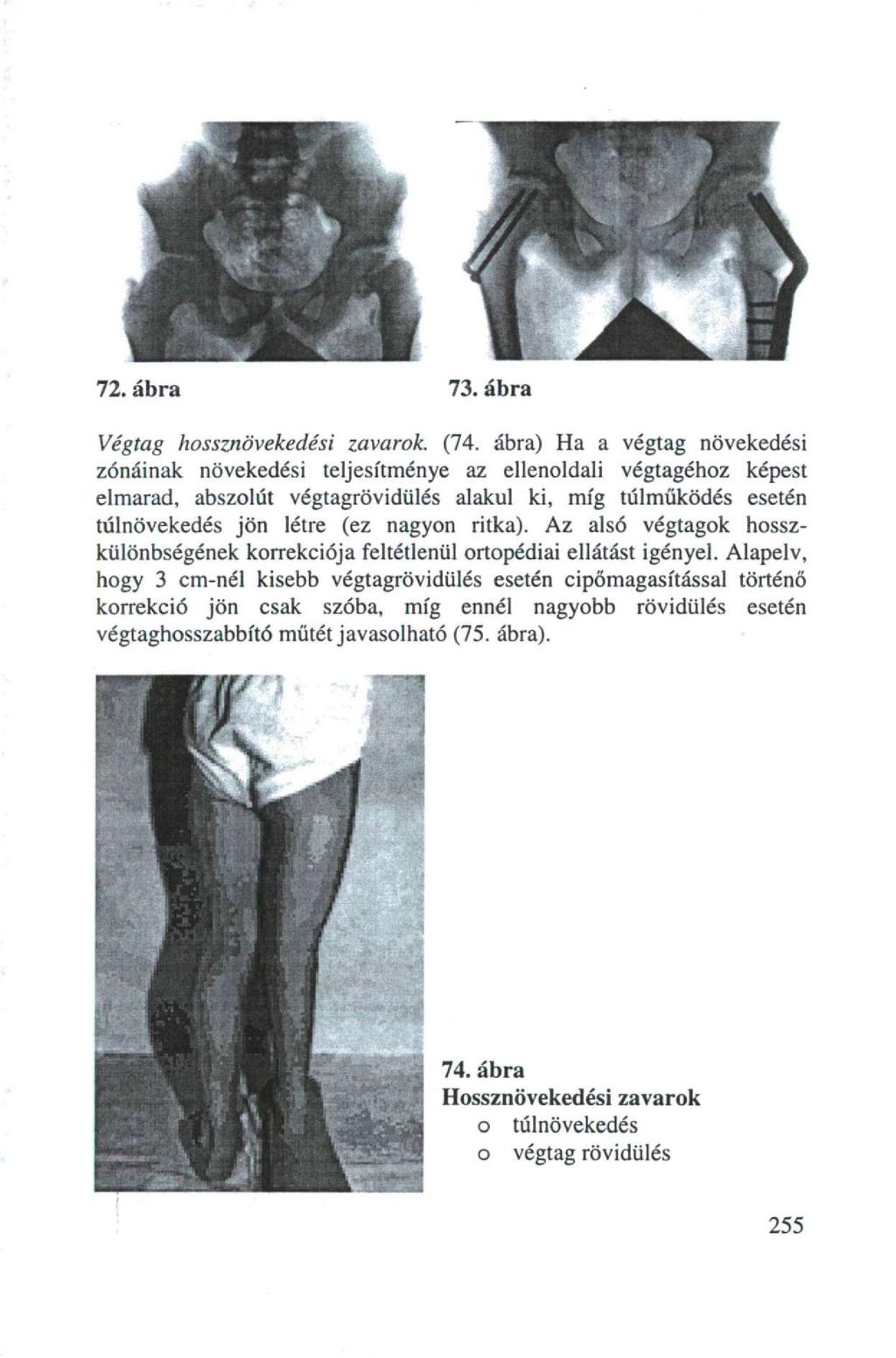 72. ábra 73. ábra Végtag hossznövekedési zavarok. (74.