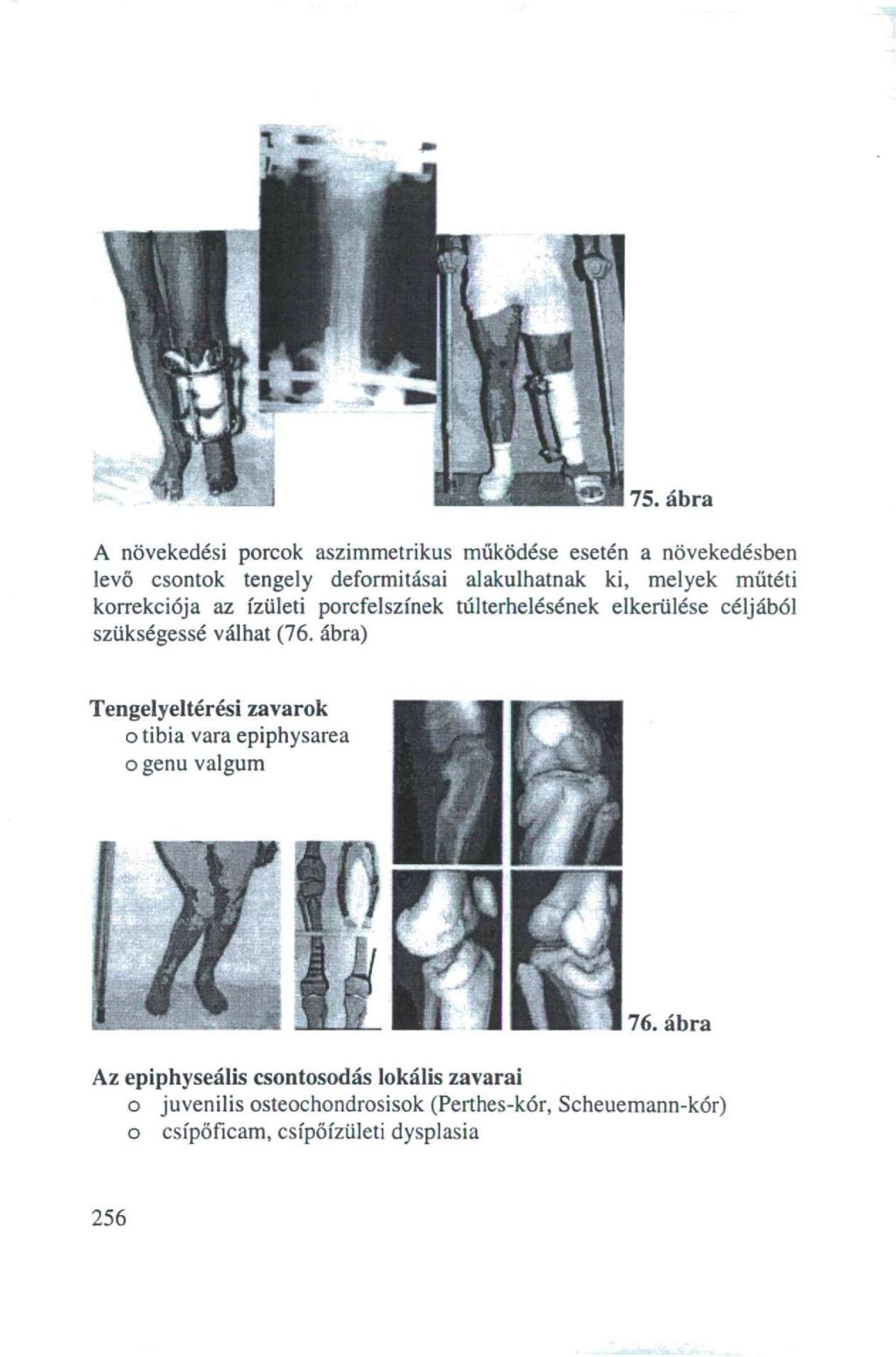 1» A növekedési porcok aszimmetrikus működése esetén a növekedésben levő csontok tengely deformitásai alakulhatnak ki, melyek műtéti korrekciója az ízületi porcfelszínek túlterhelésének