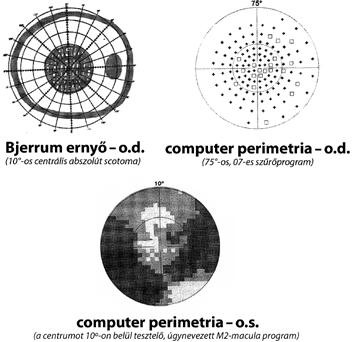 Jellegzetes szubjektív szemtünetek egy vagy kétoldali, progresszív látásvesztés esetén LÁTÁSVESZTÉS retina+/- látóideg egy / mindkét oldali szemen hirtelen kezdettel (prechiasmalis - retrochiasmális)