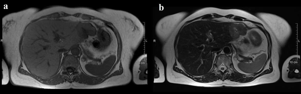 Benignus gócos májelváltozások differenciáldiagnosztikai lehetőségei MR-vizsgálattal 83.