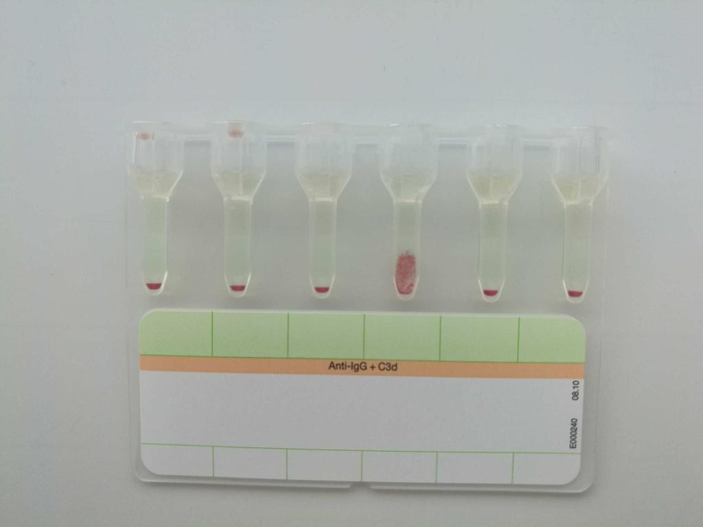 Keresztpróba: Az első 3 oszlopban 1-1 donor vvt szuszpenzió + beteg savója