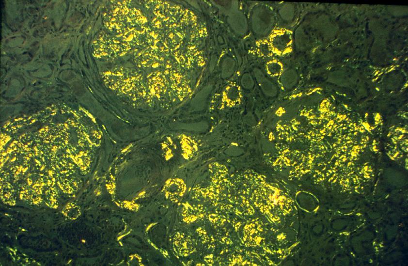 Amyloidosis Nephrosis szindróma FM: