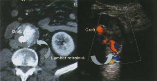 11 5. ábra. Átjárható lumbalis artériából reverz áramlás az aneurysma zsákba, 1I. típusú endoleak duplex UH-képe. (Lumbar retroleak - lumbalis artéria visszatölt.) Megbeszélés X. táblázat.