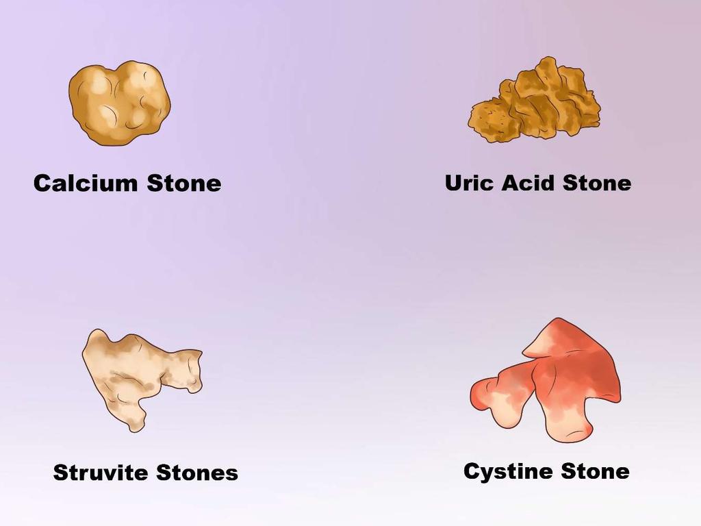 További típusok Calcium kő: a kövek 80%-a calcium oxalát vagy calcium oxalát-foszfát.