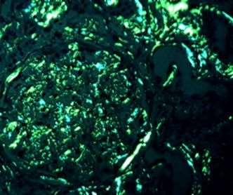 Congo vörös festéssel fénymikroszkóppal halványpiros anyag látható, polarizációs mikroszkóppal az amyloid