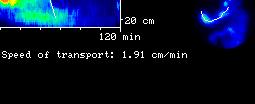 Máté: Orvosi képalkotás 128 SPECT (Single Photon Emission