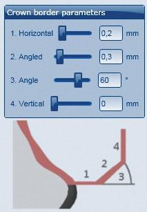 ALKALMAZÁS A szélekre vonatkozó paraméterek a Ceramill Mind CAD-szoftverben A Ceramill Zolid Preshades esetén ügyeljen arra, hogy a szélek vastagsága elég nagy legyen.