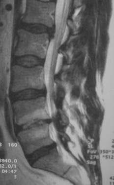 - subchondlaris cystak - lig. flavumok megvastagodása 7.ábra 3. Spondylolysis, spondylolisthesis: (8.ábra) [4] [11] A pars interarticularis hasadéka, vagy törése.