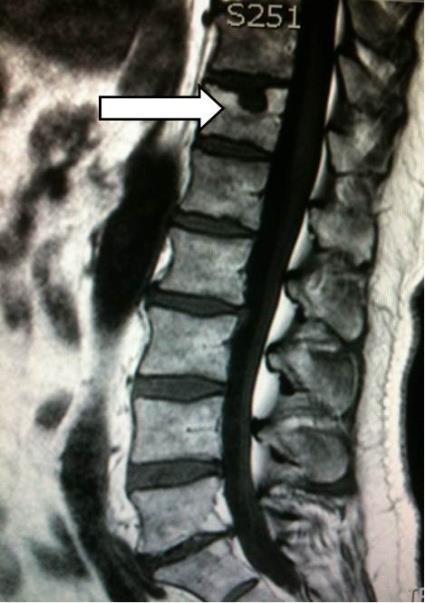 9.ábra 5. Modic-jel A gerinc degeneratív megbetegedései közé tartozik a csigolyákban lévő csontvelő betegsége. MR felvételeken Modic jel mutatja ezeket az elváltozásokat.