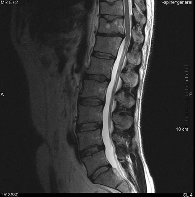 5. Esetbemutatás 1. Beteg: (1.kép) 38 éves férfi, lumbalis gerincről készült T1 és T2 súlyozott sagittalis és coronalis síkú felvétel valamint a Th XI. T1 és T2 súlyozott axialis síkú felvétel.