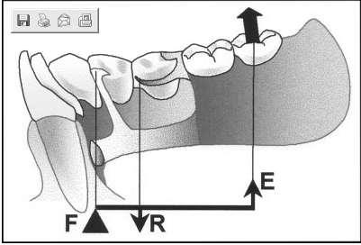 A kapocs okkluzális irányú elmozdulása - átölelve a pillérfog alámenős felszínét - fokozza a fogsor