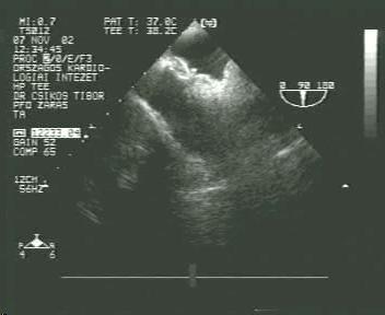 PFO