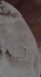 Ezek egyike a megfontolt sebészi eljárás, vagy más néven a valódi trepanáció, amelyet általában harci sérülések esetén alkalmaztak, de bármilyen, az agyterületet érintő elváltozás, kóros folyamat (pl.