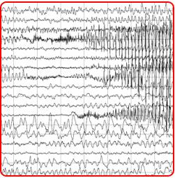 Epilepszia