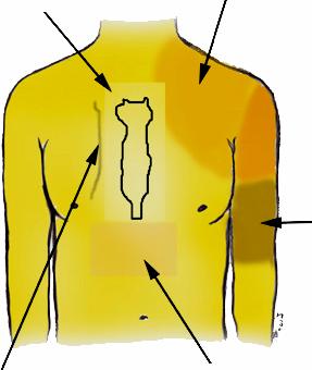 Retrosternalis: AMI Aorta dissectio Angina Tüdő embolia Spontán ptx Mitrális prolapsus Pericarditis Eosophagus Costochondritis Hát: AMI Aorta