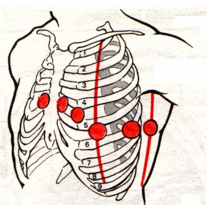 EKG-elektródok helyzete 1. V 1 jobb 4. bk. V 2 bal 4. bk. V 3 V 2 és V 4 között V 4 5.