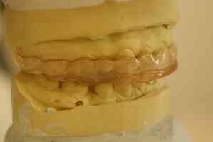 Keresztharapás esetén a fogakat és a fogpótlásokat is más helyen és más irányból éri a terhelés (progénia).