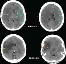 STROKE EPIDEMIOLÓGIAI ADATOK 3 típus: Ischaemiás 80% Haemorrhagiás 20% Kombinált NEMZETKÖZI ADATOK A STROKE-RA VONATKOZÓAN 15 millió új eset évente WHO kimutatása szerint nyugati világban a második