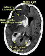 Aphasia - Neglect syndroma - Ataxia - Depresszív hangulatzavar