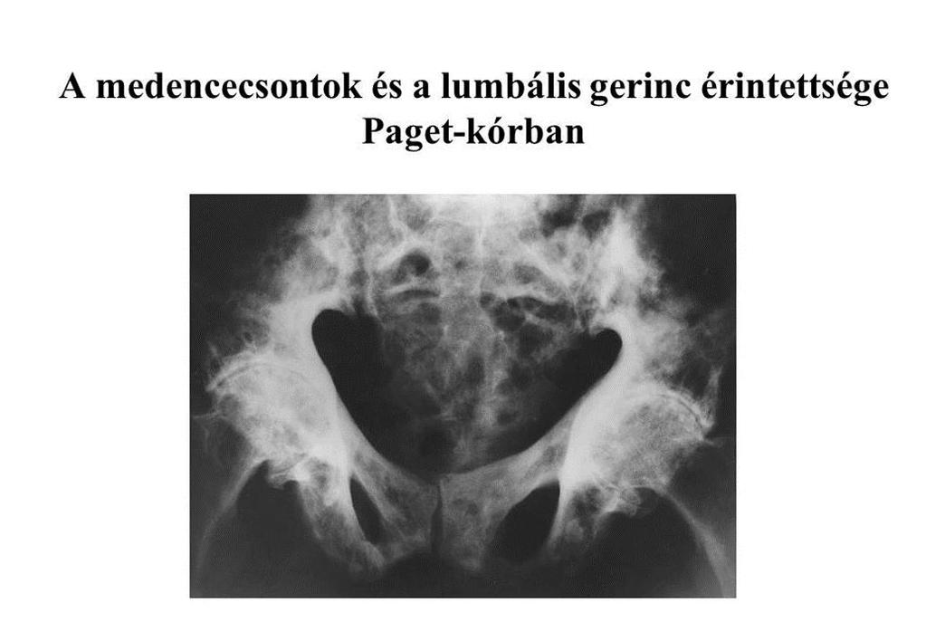 Monoostoticus(ritka) Formái Polyostotikus A betegeknek csak kb.