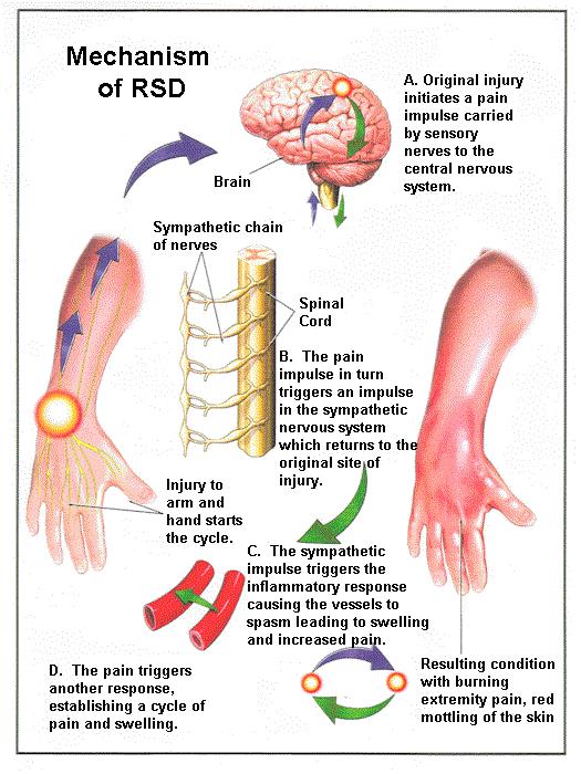 Algodystrophia pathomechanizmusa érzőideg izgalma kóros sympatikus