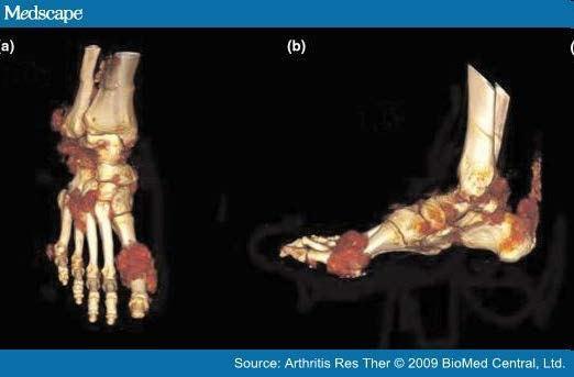 Computed tomography images demonstrating extensive tophaceous deposits.