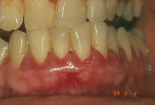 GINGIVITIS A