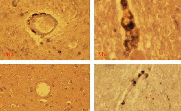 Hasonló dendritikus sejt megjelenés, T lymphocyta infiltráció mutatható ki Parkinson betegeségben elhunytak substantia nigrájában, az Alzheimer betegségben elhunytak cerebrális cortexében, Pick
