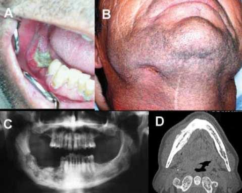 ábra: A: Három hónappal később szabaddá vált necrotikus csontot és a környező mucosa gyulladását látjuk B: extraorális fi stula a submandibularis régióban C: A panorámaröntgen-felvétel kiterjedt