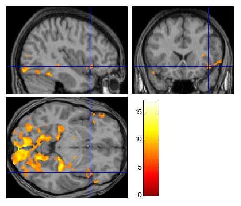 amygdala, az inzula