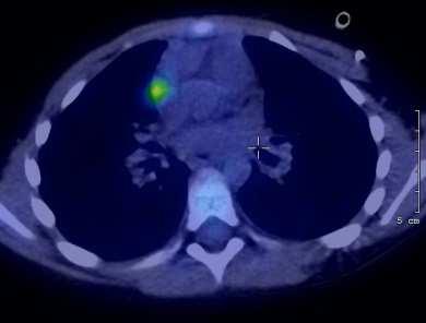 thymus rebound Gallamini A.