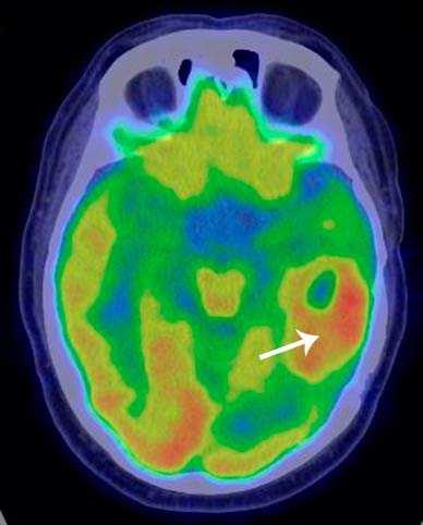 FDG-PET Grading Neuroonkológia Metabolikusan legaktívabb terület kijelölése FDG-PET Low-grade