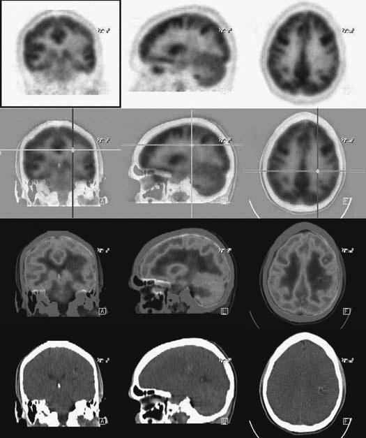 Methionine PET 11C-MET PET h00072 h00072 Glioma grade II status post resection and 60 Gy