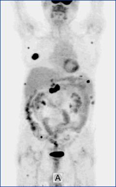 2008; 46:199-211 DLBCL, relapsus ASCT