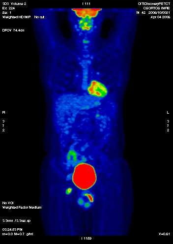 Hodgkin glutealis izom érintettség