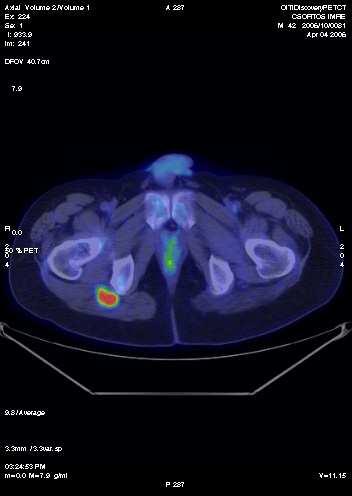 PET > CT Központi idegrendszer (agy) -