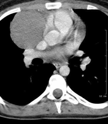 restaging PET-CT 4,5 évvel a