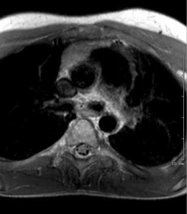 Metabolikus remissio CR - Magas