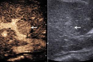 Upgraded ultrasound