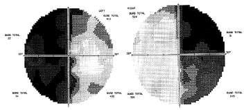 Microprolactinoma: Követés, endokrinológiai gondozás PRL: kezdetben 1-2 havonta, majd 3-6 havonta MR: (6) 12 hó, ezt követően 1-2 évente, majd ritkábban vagy panaszok esetén