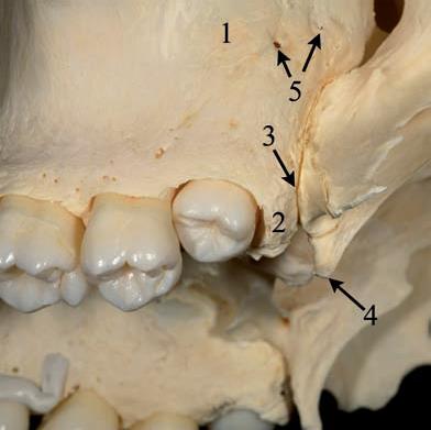 1. tuber maxillae 2. tuber retromolare 3.